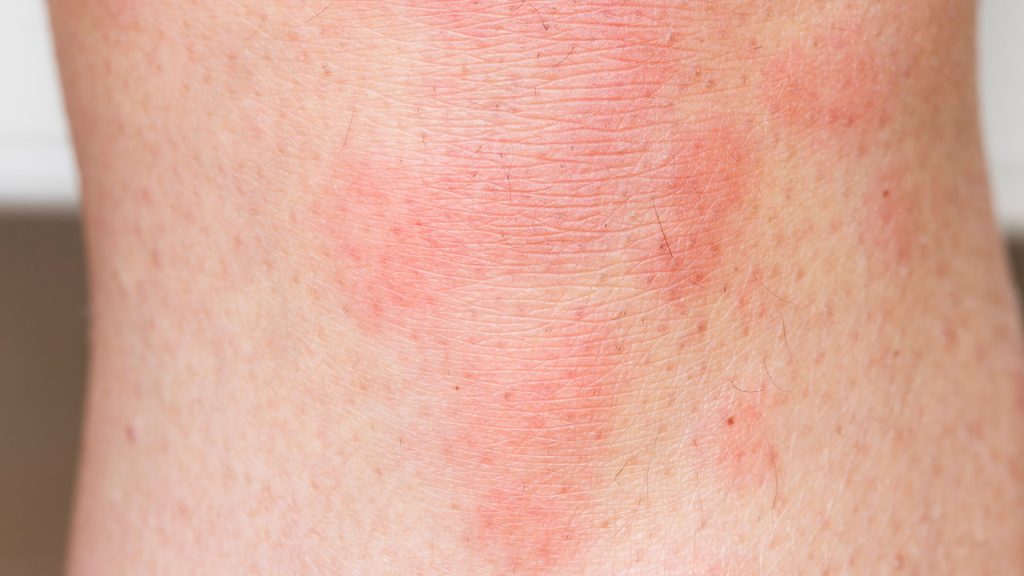 Hidradenitis Suppurativa (Hs): Skin Disease Symptoms hidradenitis suppurativa pain