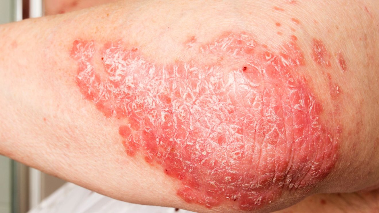 Skin Disease Symptoms | Hidradenitis Suppurativa (HS)