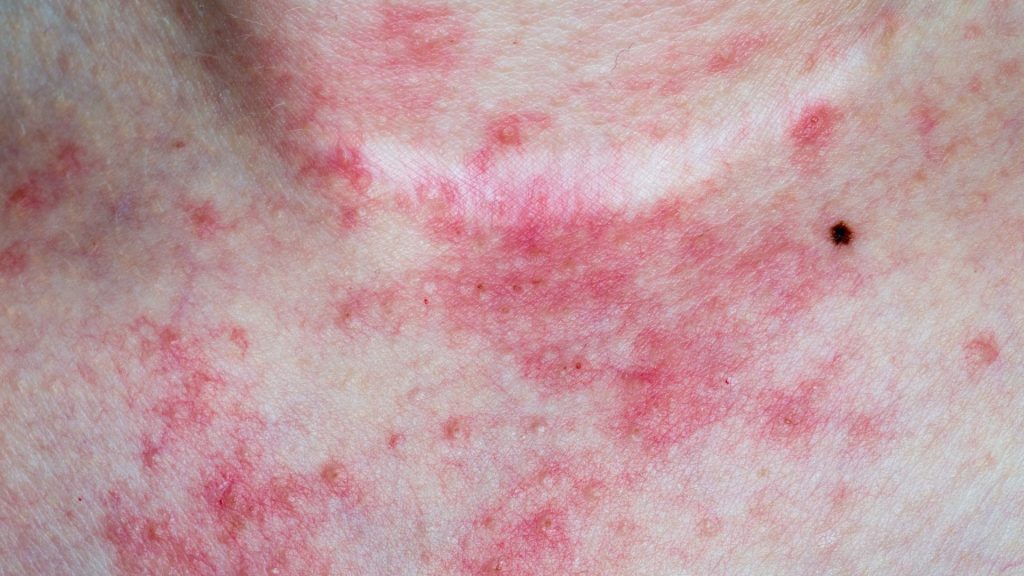 Frequently Asked Questions About Hidradenitis Suppurativa can hidradenitis suppurativa go away