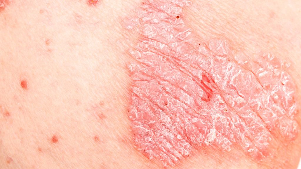 a close up of a skin with a red blister caused by hidradenitis suppurativa, a non-contagious condition.