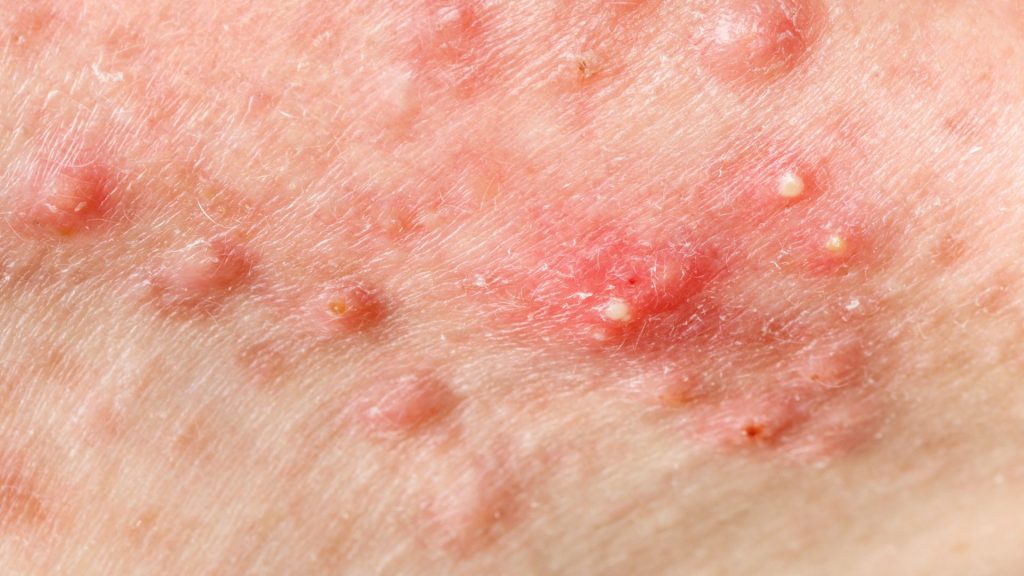 Uncovering Common Misdiagnoses Of Hidradenitis Suppurativa why hidradenitis suppurativcan be misdiagnosed
