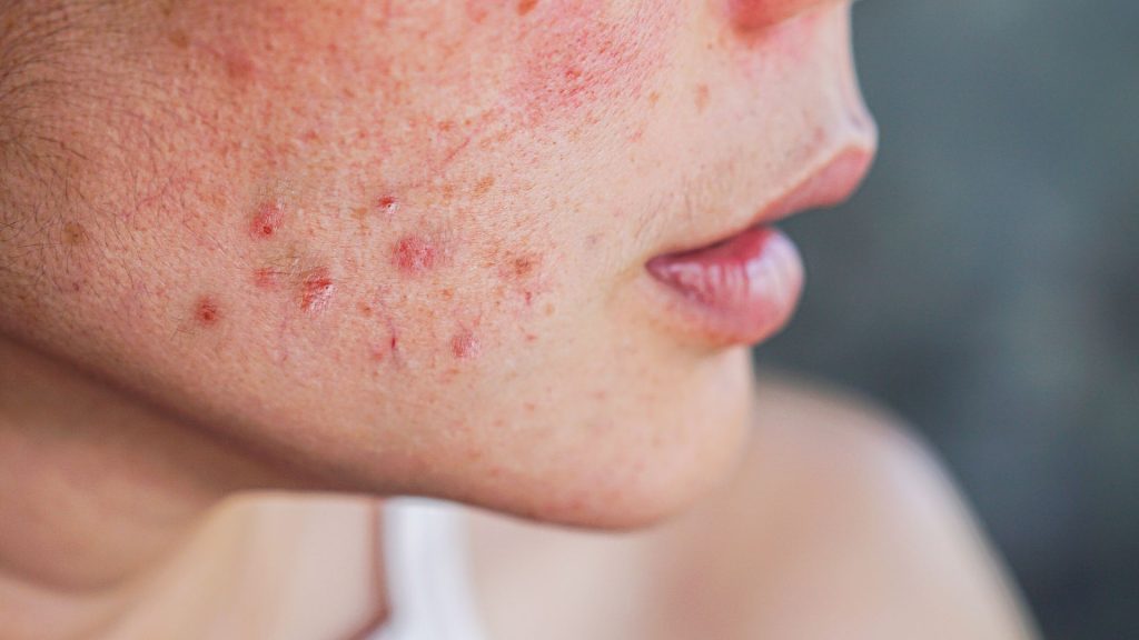Understanding Hidradenitis Suppurativa Cure: Key Facts To Know hidradenitis suppurativa condition, hidradenitis suppurativa on the face