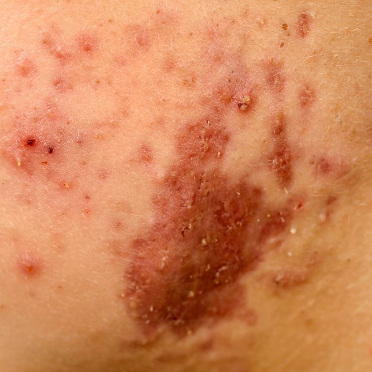 a close up of a woman with hidradenitis suppurativa scars on her neck.