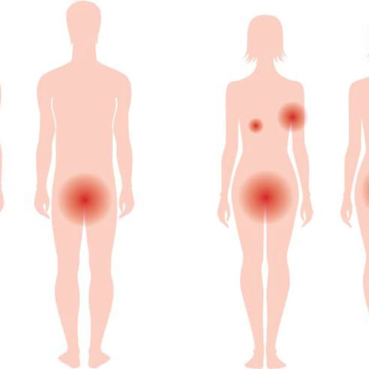 hidradenitis suppurativa in canada