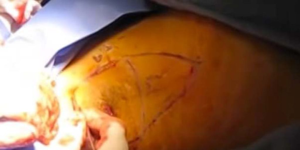 a person diligently sewing up a wound caused by hidradenitis suppurativa.