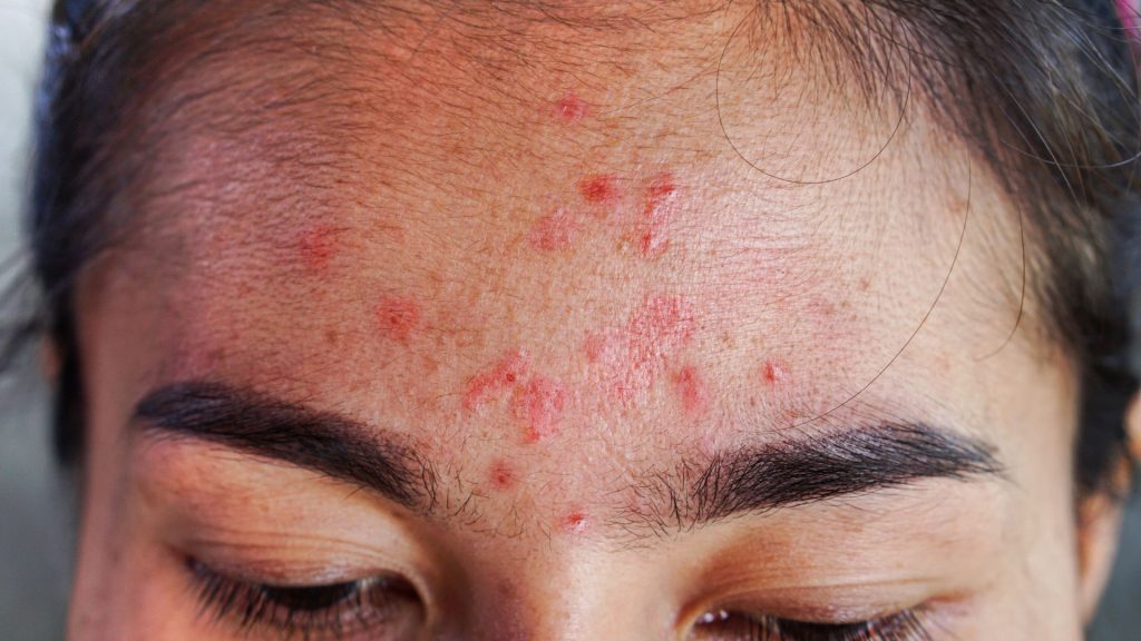 a woman managing hs pain with red spots on her face.
