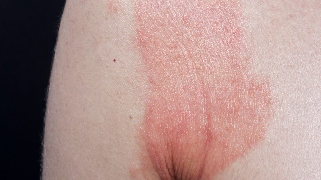 a woman's thigh with a red mark, experiencing hs pain.