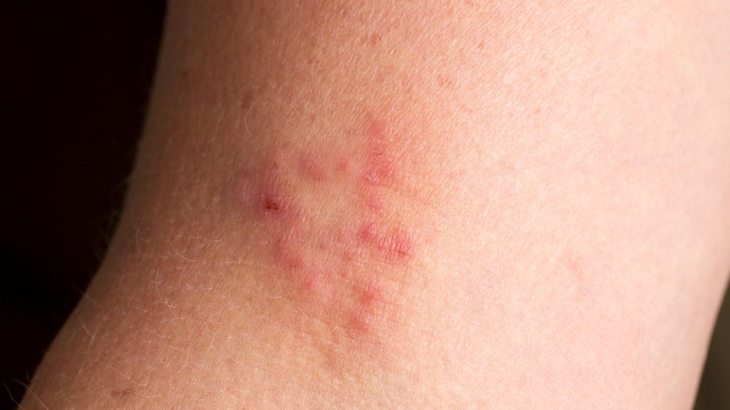 a close up of a skin with red spots, indicating the presence of hs pain.