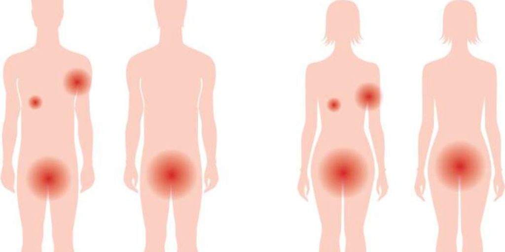 Hidradenitis Suppurativa Treatment At Home: 7 Common Questions Answered hs experts