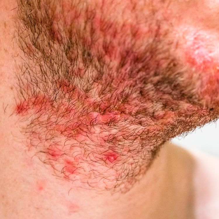 a close up of a man with a rash on his face, possibly indicating hidradenitis suppurativa or folliculitis.