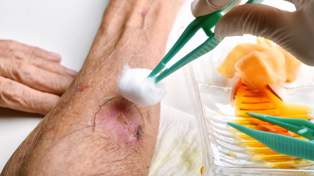 Hidradenitis Suppurativa Wound Care: What You Need To Know hidradenitis suppurativa open wound treatment