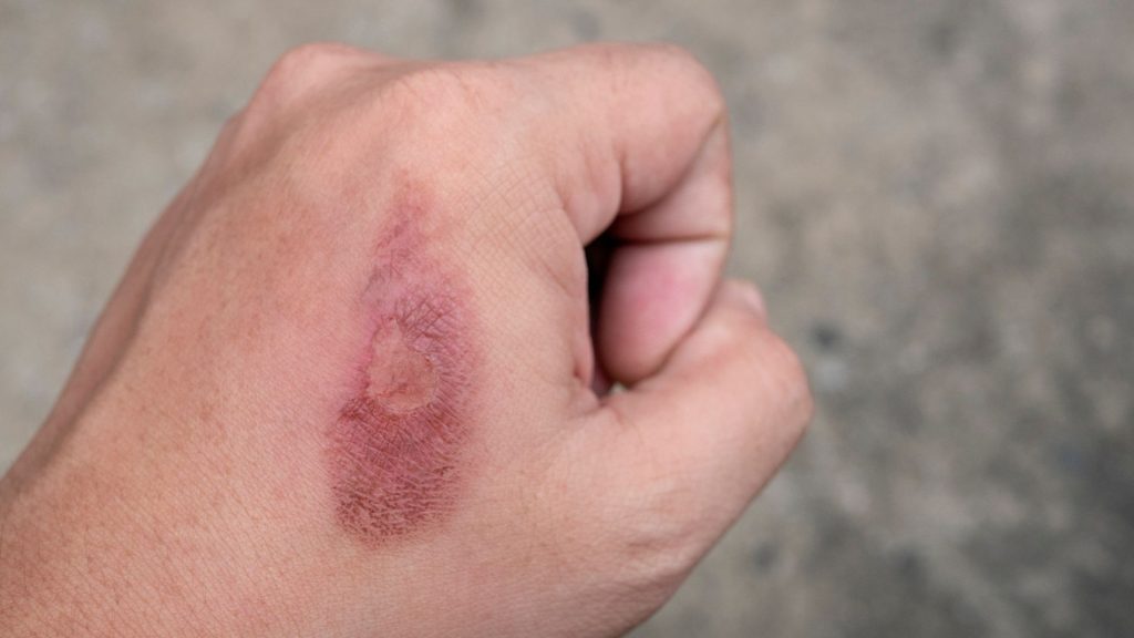 a hand with a hidradenitis suppurativa wound.