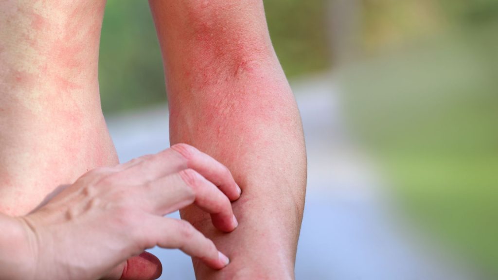an individual's arm displaying a red rash, indicating a skin condition