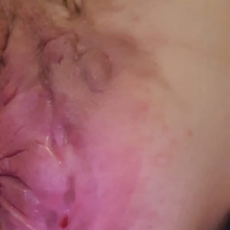 a close up of a person's face with hidradenitis suppurativa stage 3.