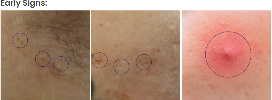 pimple under armpit