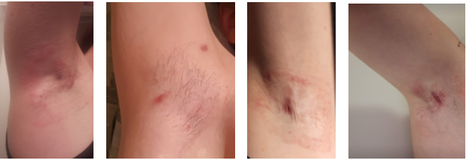 a close-up of a person's chest showcasing hidradenitis suppurativa pictures.