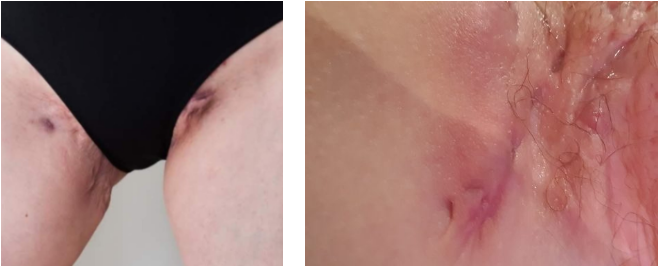 Hidradenitis Suppurativa Pictures: Visualizing The Hs before and after pictures of a woman's thigh showing the impact of hidradenitis suppurativa.