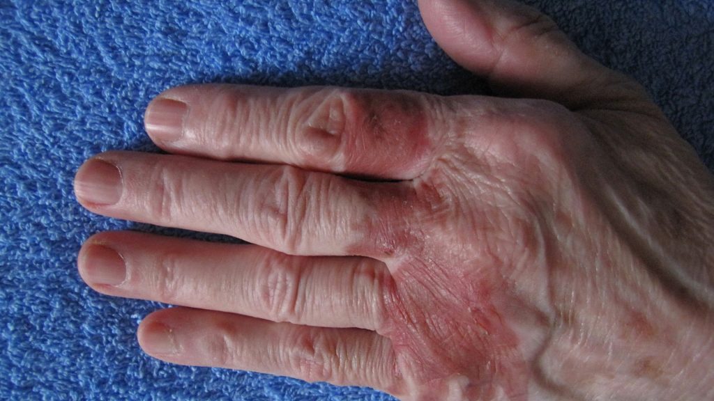 a close-up of a hand showcasing stages of hidradenitis suppurativa.