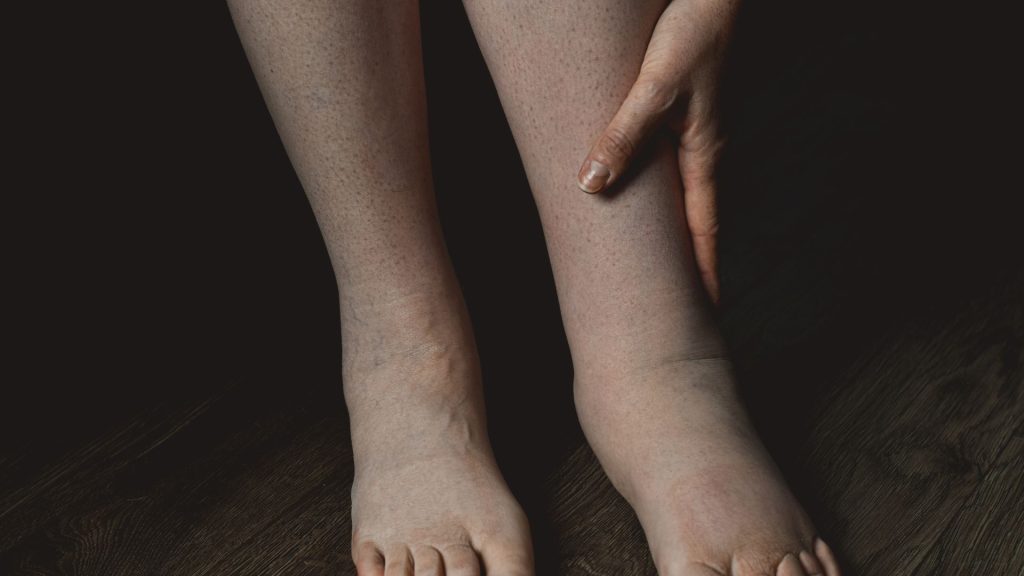 a person's legs with their feet resting on a wooden surface, showcasing the stages of hidradenitis suppurativa.