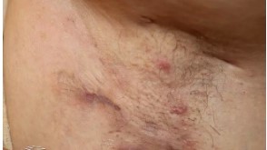 close up of a person's chest with scars from hidradenitis suppurativa stage 2.