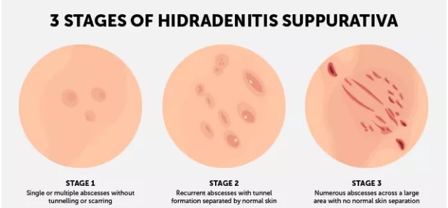 a diagram illustrating the various stages of hidradenitis suppurativa, a skin problem.