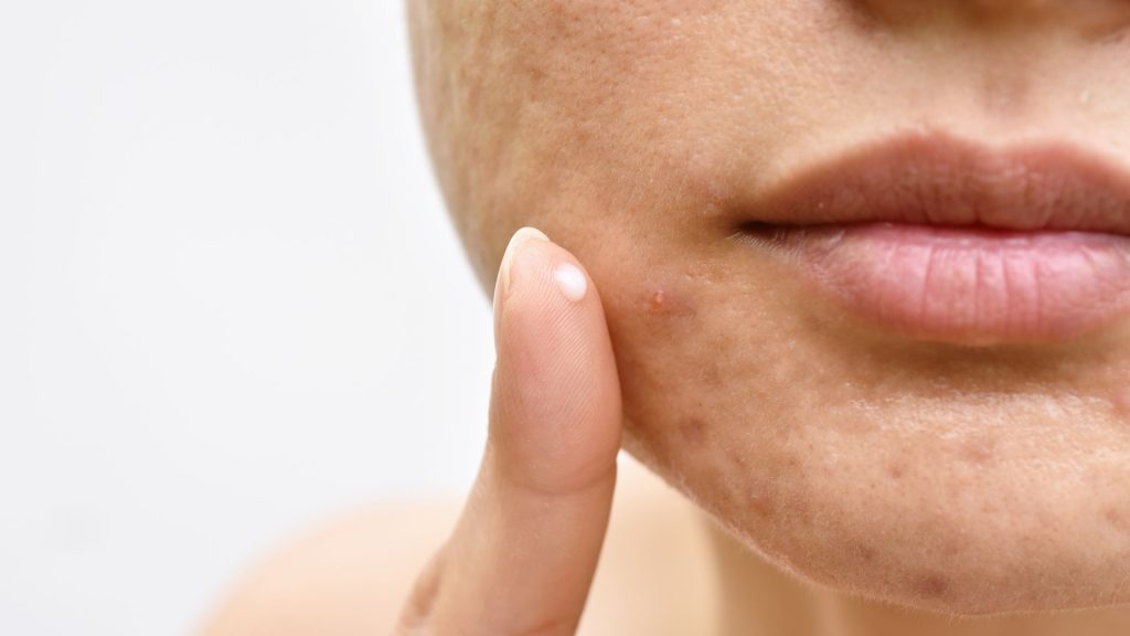 a woman is undergoing hs treatment while touching her face with her finger.