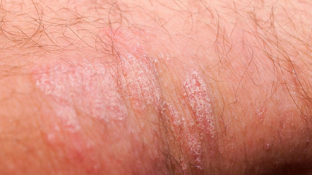 skin condition showing signs of hidradenitis suppurativa