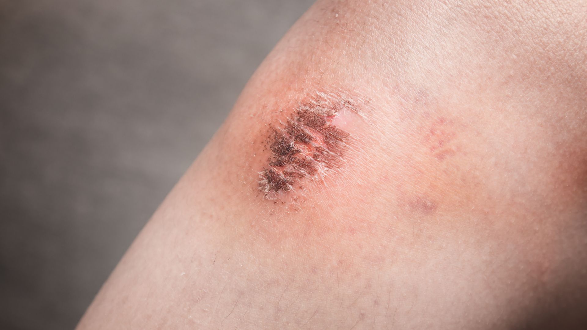 A close up of a man with a bruise on his arm receiving hs skin condition treatment