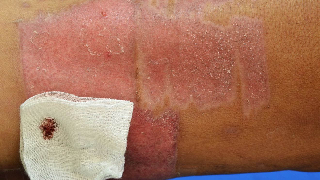 Surgical Solutions For Hidradenitis Suppurativa Exploring Options And