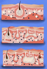 Surgical Management Of Hs stages e1751510612343